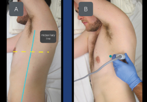 Figure 3A & B: To locate the serratus anterior muscle, place the transducer at the level of the nipple in the midaxillary line. The transducer marker (green dot) should point toward the nipple. 