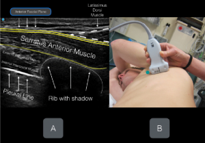 Figures 4A & B: Labeled ultrasound image with corresponding transducer positioning. Note the anterior fascial plane of the serratus anterior muscle. The goal of the planar block is to place anesthetic in this fascial plane.