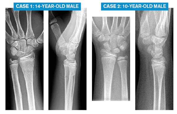 Case 1: 14-year-old male Case 2: 10-year-old male