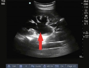 Hydronephrosis appears on ultrasound as a dilated hypoechoic (black) region in the collecting system of the kidney.