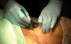 How to Make the Incision, Insert the Tube in Cricothyrotomy 