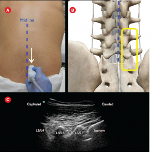 Figure 2A: The probe is moved in a caudal direction until the sacrum is noted. 2B: The articular processes as well as the top of the sacrum are seen on the anatomical drawing. 2C: Corresponding ultrasound image with labeled articular processes and sacrum