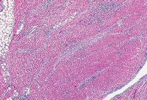 Figure 1. Above: Hematoxylin and eosin stain at 6.25x magnification of decedent heart tissue demonstrating characteristic interstitial perivascular lymphoplasmacytic pancarditis.