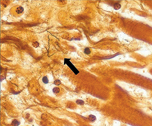 Figure 2. BELOW: Warthin-Starry stain of decedent heart tissue at 158x magnification demonstrating Borrelia burgdorferi spirochetes (arrow).