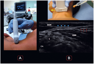 Pain Control Using Ultrasound-Guided Superficial Cervical Plexus Block