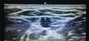 Figure 5. A vessel within the parameters for optimal depth and width for catheter placement.