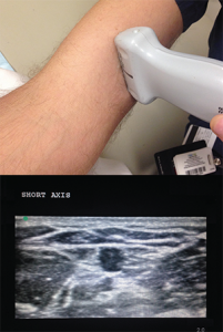 Figure 6. Short-axis positioning.