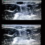 Figure 9. While there is not enough compression here to collapse the vein, there is enough to compress soft tissue. 