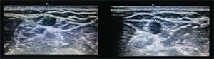 Figure 10. If catheter placement was successful, you will see turbulence inside of the vein when flushing with saline.