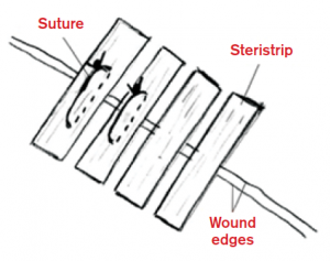 Figure 1. Davis et al applied Steri-Strips across the skin tear as anchoring devices and then sutured through them. 