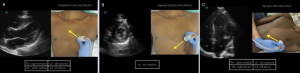 Appropriate probe positioning and corresponding ultrasound image of A) PLAX, B) PSAX, and C) A4C.