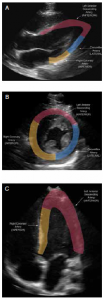 Echocardiogram images with outlined regional wall motion abnormality territories of A) PSLAX B) PSAX, and C) A4C.