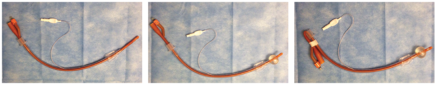 Figure 6. Place the Foley catheter through the ET tube completely (Top left). Inflate the Foley catheter to the predetermined volume and place traction on the opposite end to have it flush against the distal tip of the ET tube (Top right). Option to secure the Foley catheter to the ET tube (Bottom). 