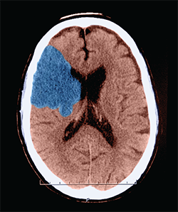 Ischemic stroke. This axial (cross sectional) CT of the head shows a classic appearance of an acute middle cerebral artery infarction (stroke) (shown here in blue). This patient showed a hyperdense MCA sign. This sign is indicative of thrombo-embolic occusion of the MCA.