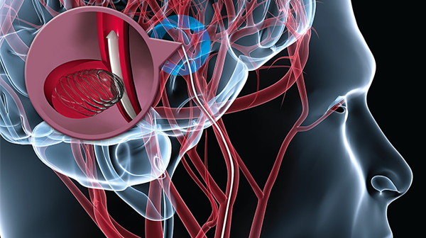 Randomized Assessment of Rapid Endovascular Treatment of Ischemic Stroke