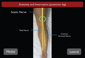 Figure 2. Sciatic nerve anatomy from the posterior aspect as it travels down the thigh into the leg.