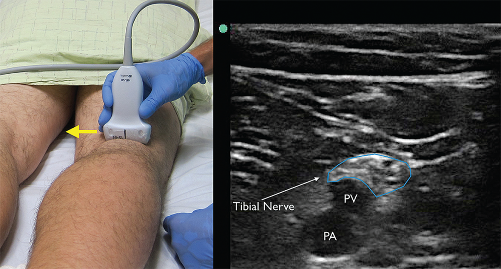 How to Perform Ultrasound-Guided Distal Sciatic Nerve Block in the