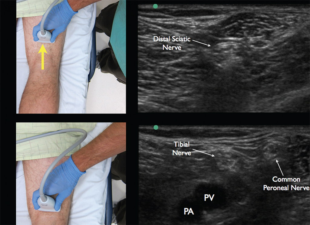 Tibial Nerve Block Ultrasound