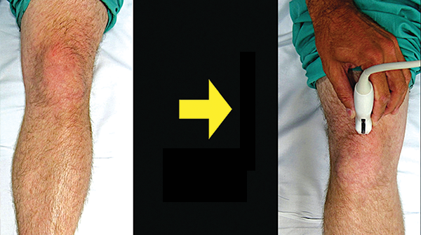 How to Perform Ultrasound-Guided Knee Arthrocentesis