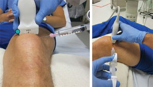 Figure 3. Rotate the probe marker to the patient’s right in order to visualize a transverse view of the prepatellar space with the effusion.