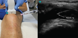Figure 4. Enter the skin lateral to the probe using an 18g needle attached to a syringe for an in-plane arthrocentesis while visualizing the needle tip.