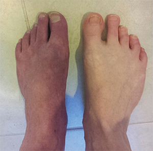 Feet of a patient with more advanced CRPS, which show clear skin atrophic changes.