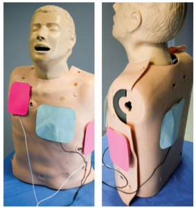 Figure 1. Orientation of defibrillation pads for double sequential external defibrillation: anterior-posterior (blue) and anterior-apex (pink).