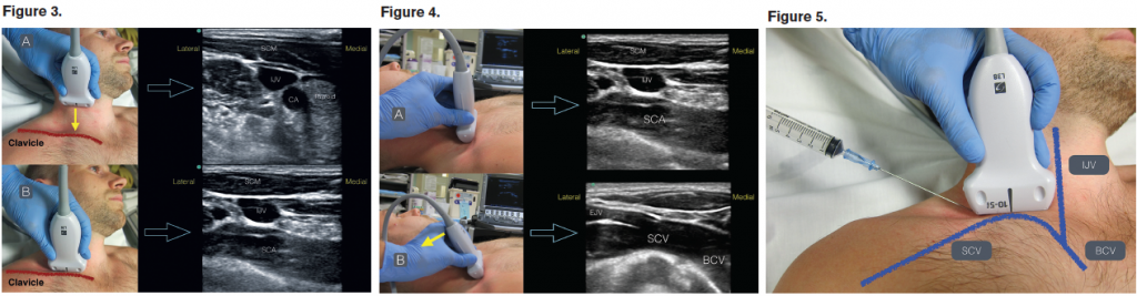 Figure 3. (A) In a transverse plane on the neck, locate the thyroid, IJV, and carotid artery (CA) deep to the sternocleidomastoid (SCM) muscle. (B) Slide the transducer down the IJV into the supraclavicular fossa until the subclavian artery (SCA) is noted. Figure 4. Angle the probe anteriorly (solid yellow arrow) to visualize the SCV as it joins the brachiocephalic vein (BCV). The external jugular vein (EJV) may be seen joining the SCV at this location. Figure 5. An in-plane technique will be used with the needle entering the skin just lateral to the ultrasound transducer. The operator should use the nondominant hand to stabilize the transducer on the patient’s neck. SCV; IJV; BCV.