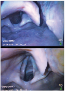 Figure 1 (Left). Blade positioning and Kovacs' sign. In the upper image (ideal placement), the cricoid ring is not seen. There is more room beneath the posterior larynx on the monitor screen, which is critical for observing tube delivery. In the lower image, the cricoid ring and the internal aspect of the criothyroid membrane are visible between the vocal cords, indicating over-insertion of the hyperangulated blade and a steep angle of approach.