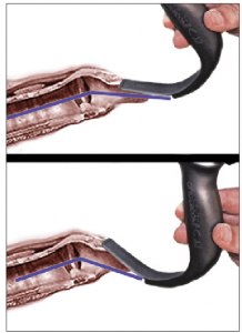 Figure 2 (Right). Schematic representation of the angle of approach. The top image shows ideal placement of a hyperangulated blade—in this case, a GlideScope Titanium blade—compared to overinsertion (bottom image). Note that the approach angle is more acute and that there is less room for tube delivery between the blade and the larynx.