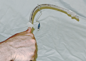 Figure 4. Right-turn overhand technique for hyperangulated stylet insertion into the trachea. By turning the stylet and tube 90 degrees, the tube angles downward, aligning with the inclination of the trachea. Note that the tube can be advanced in small increments off the stylet using the right hand only as long as an overhand grip is used at the top of the tube and stylet.