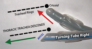 Figure 5. Turning the tube right improves interaction with trachea rings (corrugation and inclination) with a left-bevel tube. Whenever inserting trachea tubes with a left-bevel tube, if resistance is felt beneath the vocal cords, a gentle rightward turn will solve the problem in most instances.