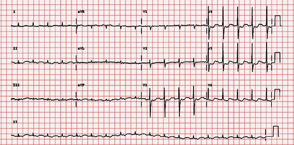 Modified Valsalva Maneuver Better Way to Manage Supraventricular Tachycardia