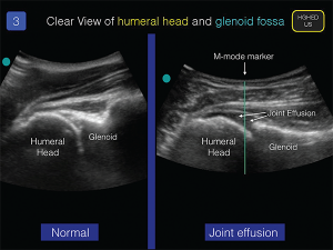 Figure 3. Using the same technique detailed in Figure 2, examine the affected glenohumeral joint.