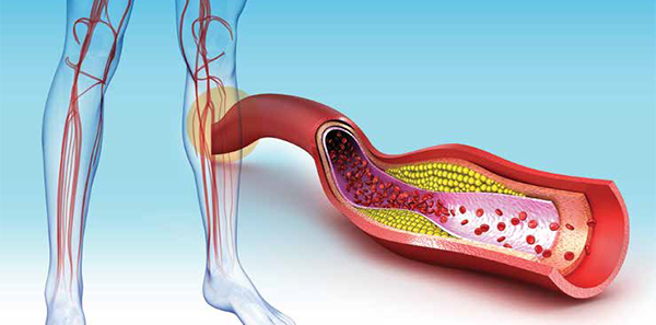 Options, Approaches to Outpatient Treatment of Deep Vein Thrombosis for Emergency Physicians