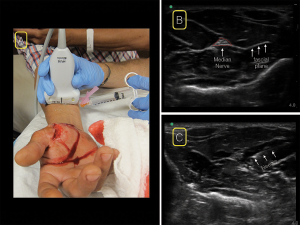Figure 3. For the median nerve block, place the linear ultrasound probe in a transverse position at the wrist crease on the volar surface of the distal forearm. Scan proximally to the mid-forearm (A) and look for the classic “honeycomb” appearance of a nervous structure at the junction of several fascial planes (B). insert your needle from whichever side is most comfortable (A&C).