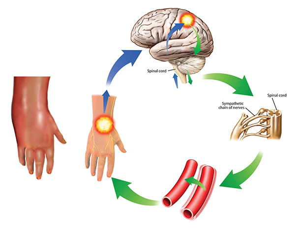 Complex regional pain syndrome This condition is also known as reflex sympathetic dystrophy. The symptoms can worsen over time and spread through the body as they are reinforced in the cycle shown here. The sympathetic response (green) from the brain (upper right) to the pain impulses (blue) cause vessel spasms (lower right) that increase the pain. In this case, the pain and swelling are in the hand, but other areas of the body can also be affected. It is severely painful and treatment is difficult, involving drugs, electrical stimulation, and psychological and neurological forms of therapy.