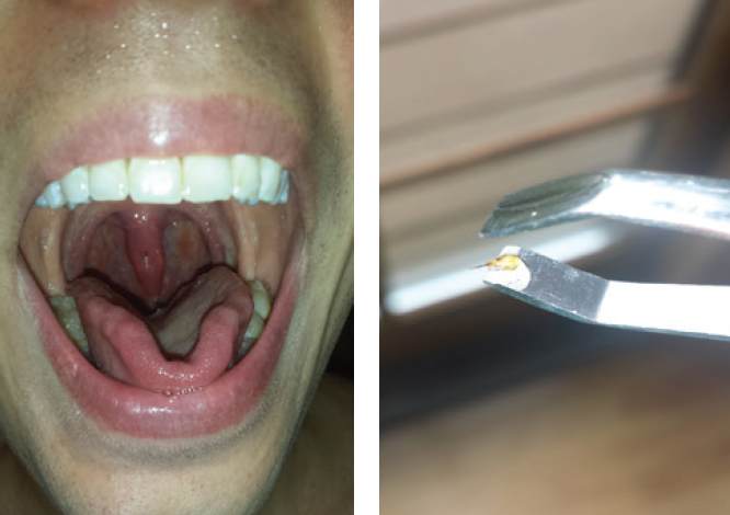 Figure 1 (left): Dr. Podolej’s uvula with the bee stinger embedded in the mucosa. Figure 2 (above): The bee stinger with attached empty venom sac after removal.