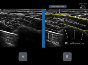 Figures 5A & B: Unlabeled (A) and labeled (B) ultrasound image.