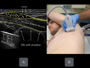 Figures 6A & B: Anesthetic deposition in the anterior fascial plane above the serratus anterior muscle.