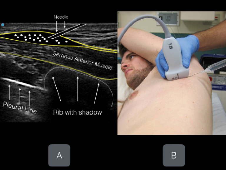 UltrasoundGuided Serratus Anterior Plane Block Can Help Avoid Opioid