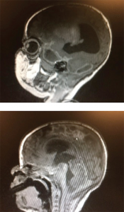 Figure 1 (TOP): Sagittal brain MRI demonstrating a focal area of ischemia (arrow) secondary to meningitis. Figure 2: Sagittal brain MRI. The ring-encasing lesion (arrow) is demonstrative of subdural empyema in the midbrain secondary to bacterial meningitis.