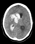 Figure 2 (TOP RIGHT): Brain computed tomography showed intracranial hemorrhage of the right basal ganglia as well as an intraventricular hemorrhage and a significant midline shift. 