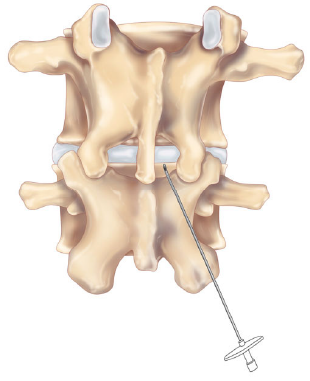 Figure 1: Posterior view of the lumbar spine.