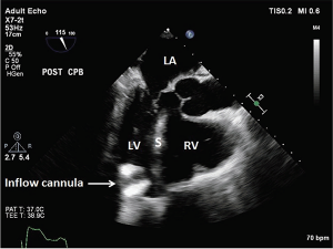 Figure 3: Suction Event, LV < RV. The inflow cannula turned and faced the interventricular septum. LA = left atrium; LV = left ventricle; S = interventricular septum; RV = right ventricle. 