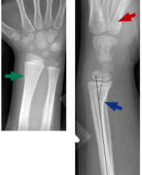 Patient 4: 6-year-old female 