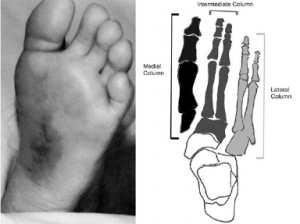 Figure 3: Left: Plantar ecchymosis. Right: Medial, intermediate and lateral column associated with midfoot biomechanics.