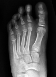 Figure 4A(ABOVE): Initial AP non-weight-bearing radiograph shows normal alignment of the medial and middle columns of an 11-year-old boy after a fall. Credit: RadioGraphics. 2014;34(2):514-531.