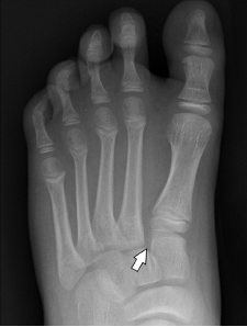 Figure 4b(BELOW): AP weight-bearing radiograph shows widening of the joint seen as a gap of more than 2 mm between C1 and M2 and between M1 and M2 (arrow).