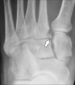 Figure 6: AP weight-bearing radiograph showing a small chip fracture from medial margin of base of M2, known as the “fleck sign.”